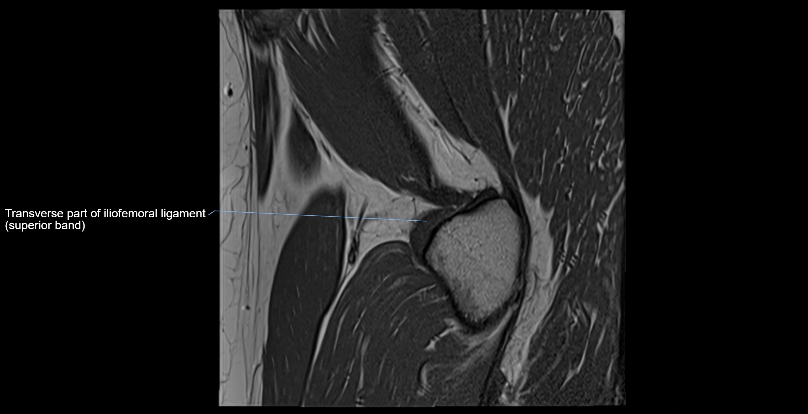 MRI Hip ligaments sagittal cross sectional anatomy 3T  radiology  image-img-00001-00022.webp
